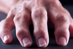 Les principales différences d'arthrite et d'arthrose