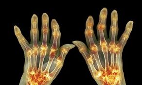 Quelle est la différence entre l'arthrite arthrohrose des articulations